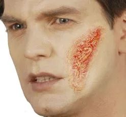 Brandwond, Professioneel